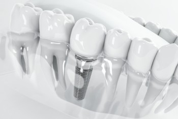 Czym są implanty stomatologiczne?