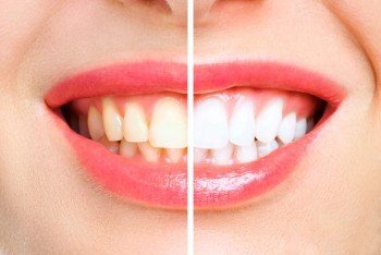 Higiena jamy ustnej po zabiegu wybielania zębów