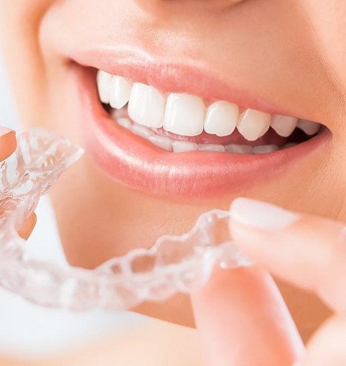 pro sile - leczenie ortodontyczne nakładkami